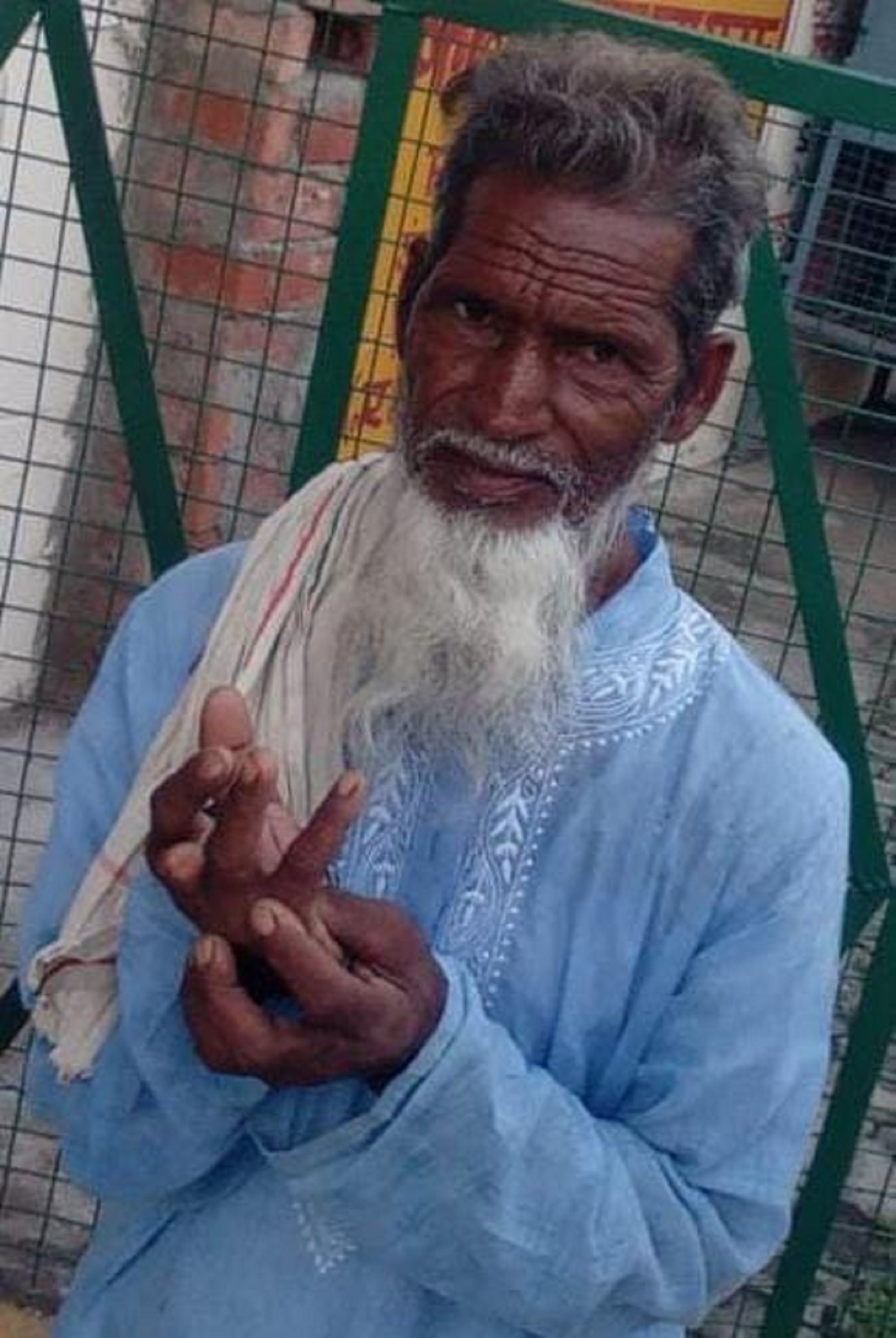 Wसर्पदंश से घबराये बुजुर्ग आये अस्पताल, बच गई जान